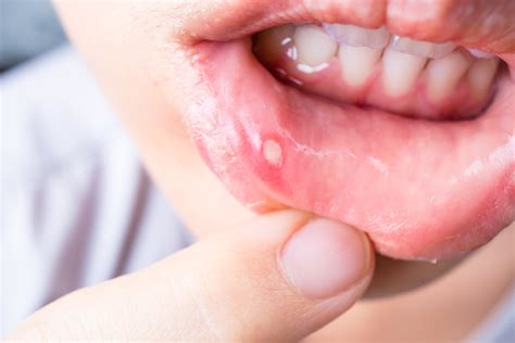 Canker Sores: Causes, Symptoms and Treatment- Rockland Dental Specialists