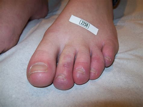 Chronic chilblains | The BMJ