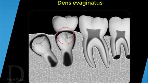 Dens evaginatus - YouTube