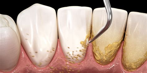 Scaling Root Planing Before And Stains