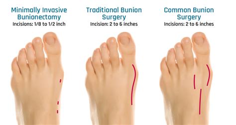 Minimally Invasive Bunion Surgery & Recovery - EVFAS