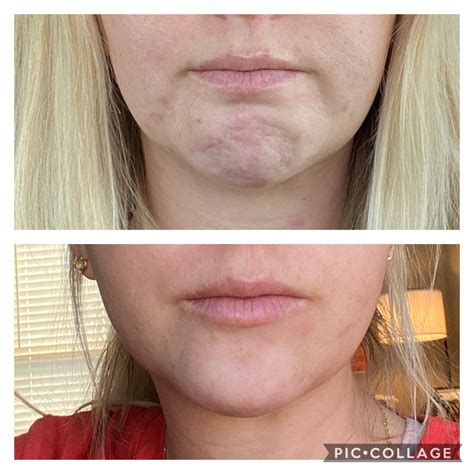 10 units of Botox completely fixed the dimpling in my chin. $80 well spent! : r/PlasticSurgery