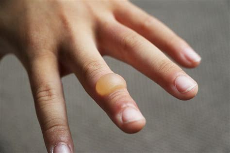 Finger Burn Blister Treatment at Norris Innes blog