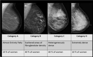 The Connection Between Dense Breasts and Breast Cancer - Patricia ...