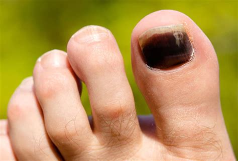 How Do You Get Dry Blood Out From Under Your Nail - Cotter Sublexperve