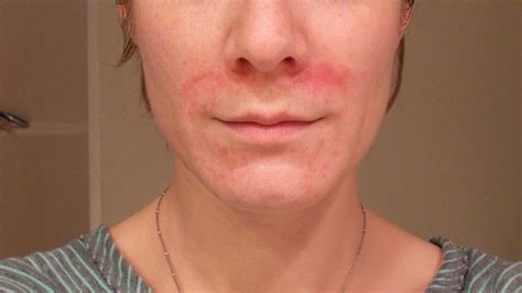 Face Skin Rashes Identification | Images and Photos finder