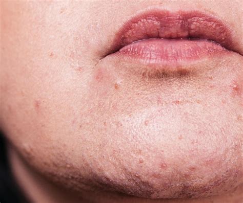 Fordyce Spots on Lips Treatment - Healths Digest