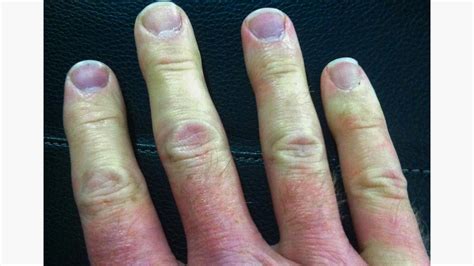 Raynaud’s Syndrome (Phenomenon): Symptoms and More