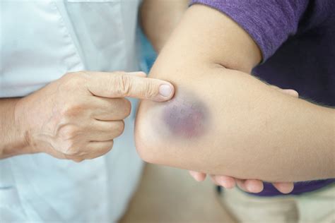 Hematoma | Physiotherapy News