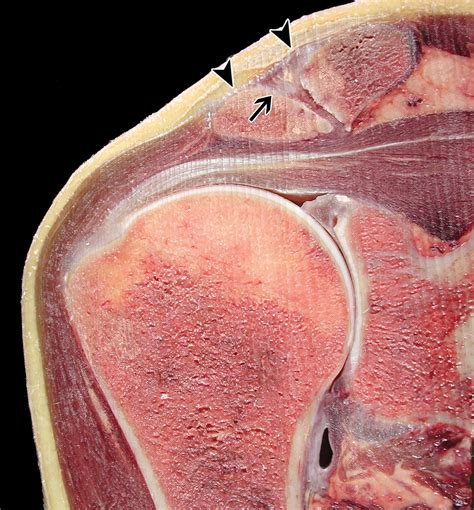 Imaging of the Acromioclavicular Joint: Anatomy, Function, Pathologic Features, and Treatment ...