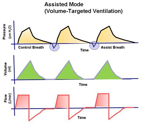 EmergenMed Health Blog: Ventilación mecánica