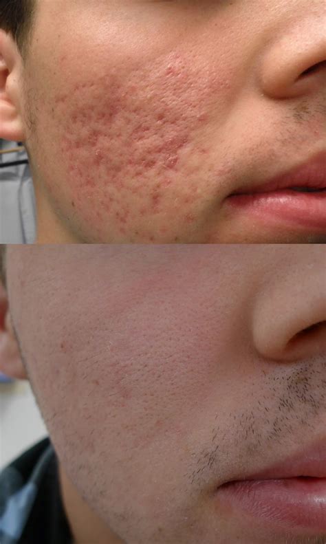 CO2 Laser Resurfacing For Acne Scars - Cutis Dermatology