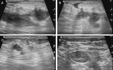 Chronic granulomatous mastitis: Imaging, pathology and management - European Journal of Radiology