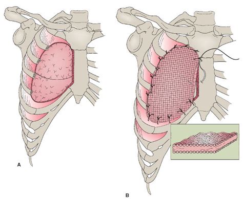 SurgicalCORE | Table/Figure