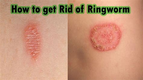 Ringworm In Kids Ways To Prevent And Treat Them - vrogue.co
