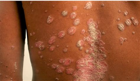 FDA approves new drug for treatment of plaque psoriasis - Healthwise