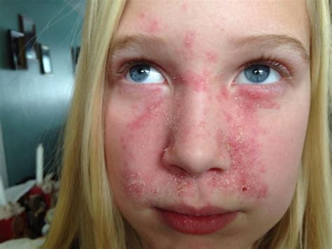 Before GAPS (Gut and Psychology Syndrome) sweet Gracie was suffering from Seborrheic Dermatitis ...