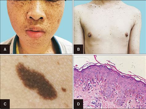 Juvenile Patient with LEOPARD Syndrome: Clinical Profile of a Genetically Confirmed Case