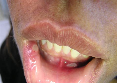 Syphilis Chancre Tongue