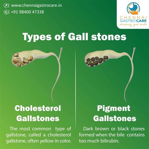 Gallstone Types - Chennai Gastro Care | Gallstones, Gallstones symptoms, Bladder