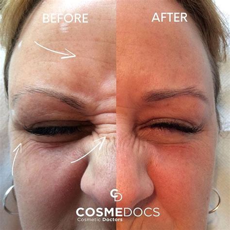 Bunny Lines Botox | Nose Wrinkles Treatment | CosmeDocs London