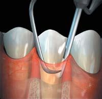 Dentistry and Medicine: Value of Coronal Scaling and Subgingival ...