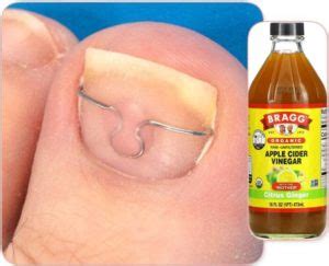 Apple Cider Vinegar for Toenail Fungus. How does It work?