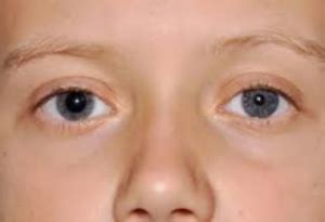 Conditions that Affect the Pupil - Optometrists.org