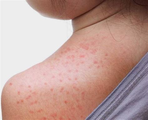 Suffering From Sweat Rashes? These Home Remedies Will Cure & Soothe You ...