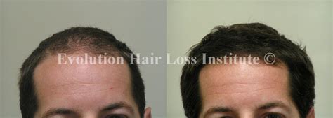 Before and After Hair Growth Treatment Photos