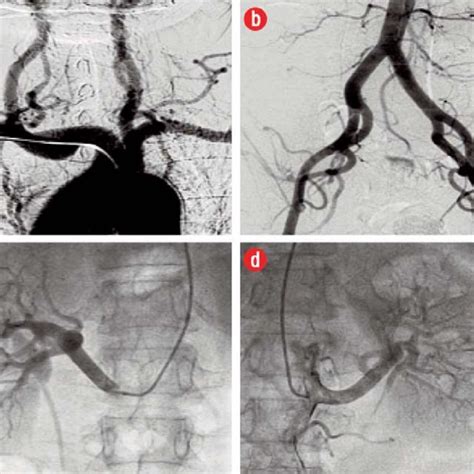 Angiogram of the left anterior descending (LAD) coronary artery in the ...