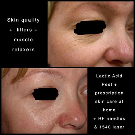 Lactic Acid Peel - Vista Clinic Melbourne