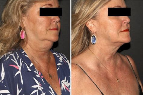 CoolSculpting® Chin Fat Results Before & After | San Antonio & Boerne