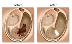 Ossiculoplasty | Ear Nose Throat