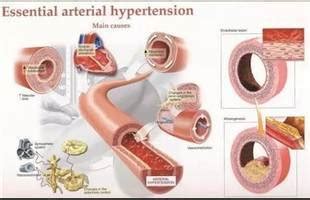 Hipertensi Primer : Definisi, Epidemiologi & Penatalaksanaan