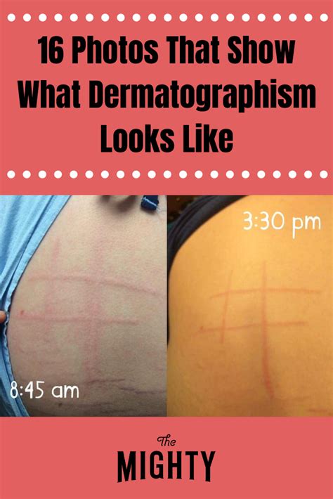 16 Photos That Show What Dermatographism Looks Like | Chronic Illness ...