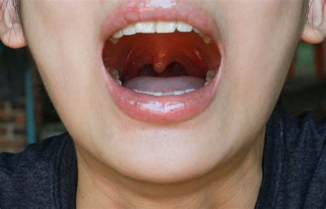 All About Uvulitis and Why it Can Occur - Illnesses - Step To Health