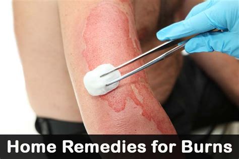 20 DIY Home Remedies for Burns | Home remedies for burns, Remedies ...