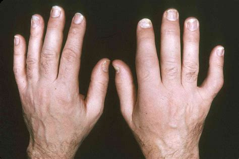 Psoriatic Arthritis Pictures