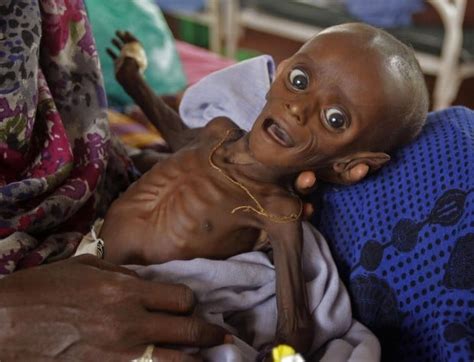 800,000 starving children are famine's distressing face | AP World News ...