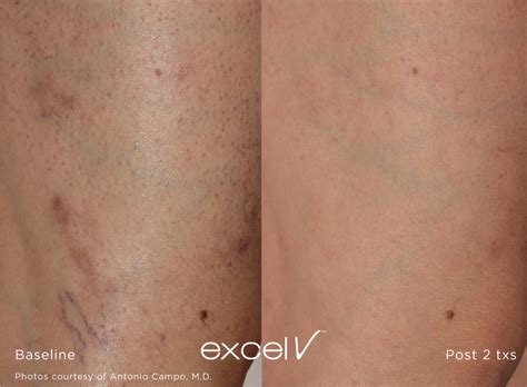 Excel V Vascular Laser Vascular Pigmentation Laser Treatment Before ...