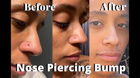 How to get rid of a nose piercing bump - My Journey - YouTube