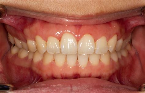 healthy gums Keep your gums healthy with your dentist in el reno ...