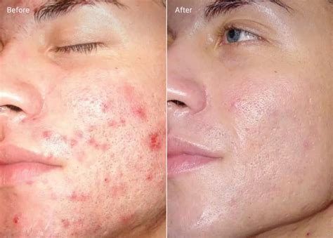 Microdermabrasion Before and After (Results + Pictures) - the daily glimmer