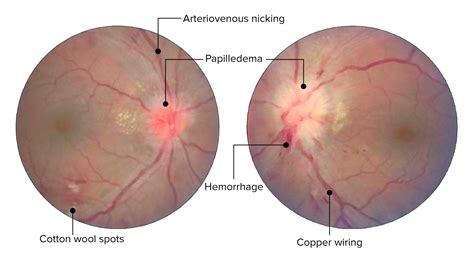 Hypertensive Retinopathy Grade 1