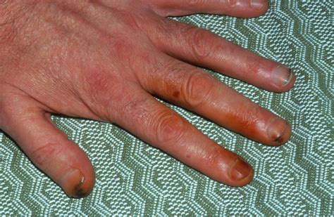 Hand With Tar Stains From Cigarette Smoking Photograph by James ...