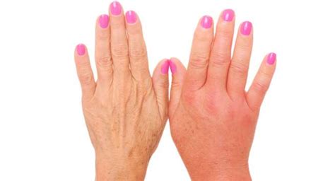 5 home remedies for swollen fingers | TheHealthSite.com