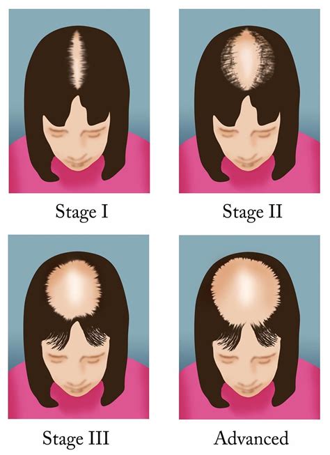 Medical for Us: Hair Loss : Types, Cause, Prevention, Treatment