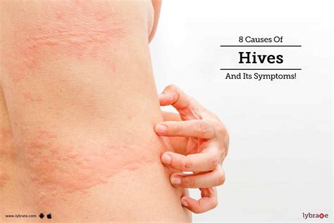 8 Causes Of Hives And Its Symptoms By Dr Archit Aggar - vrogue.co
