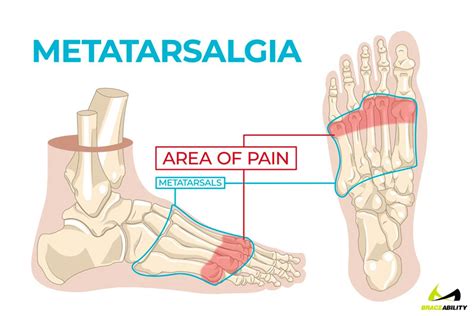 10 Facts about Forefoot pain (a.k.a. Metatarsalgia)